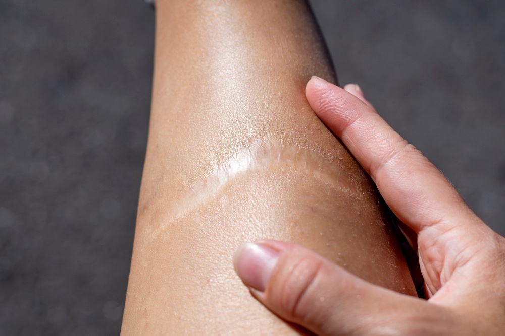 Permanent Scarring Can Increase the Value of a Personal Injury Claim