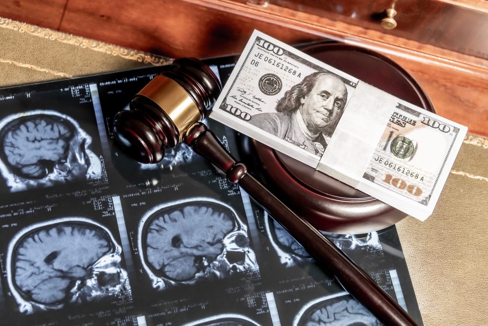 The Hidden Costs of Traumatic Brain Injuries After an Accident